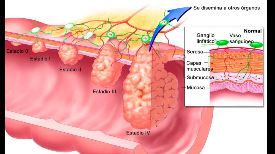 Desarrollo del cáncer de colon. Foto: Clínica Planas