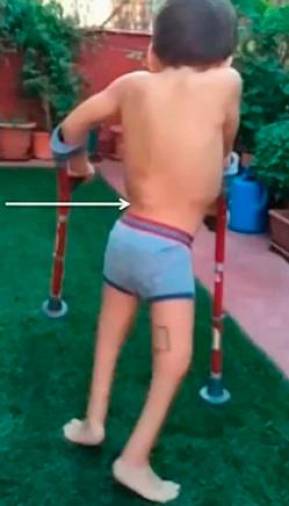 ÉXITO. En la actualidad el niño madrileño camina sin bastones.
