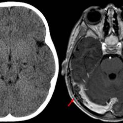 Afectación del cerebro de un paciente aquejado de trombosis de senos venosos cerebrales. Foto: Commos