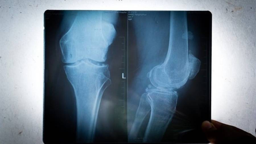 Artrosis de rodilla, consejos para evitar el dolor