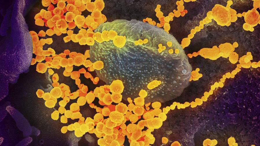 En esta fotografía microscópica coloreada se puede ver cómo el tejido celular humano está siendo invadido por el virus SARS-CoV-2 pintado en amarillo. (Fuente, www.nationalgeographic.com)