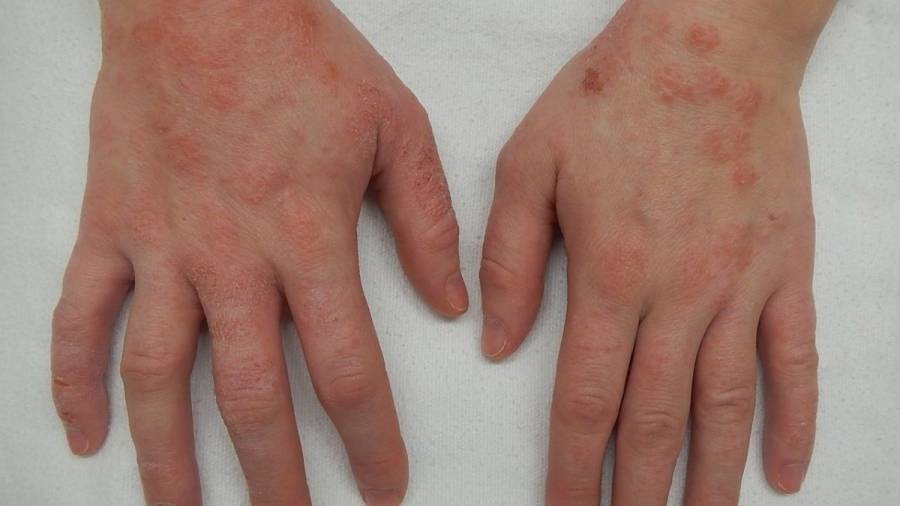 La dermatitis atópica afecta a un 30% de la población infantil en los países occidentales